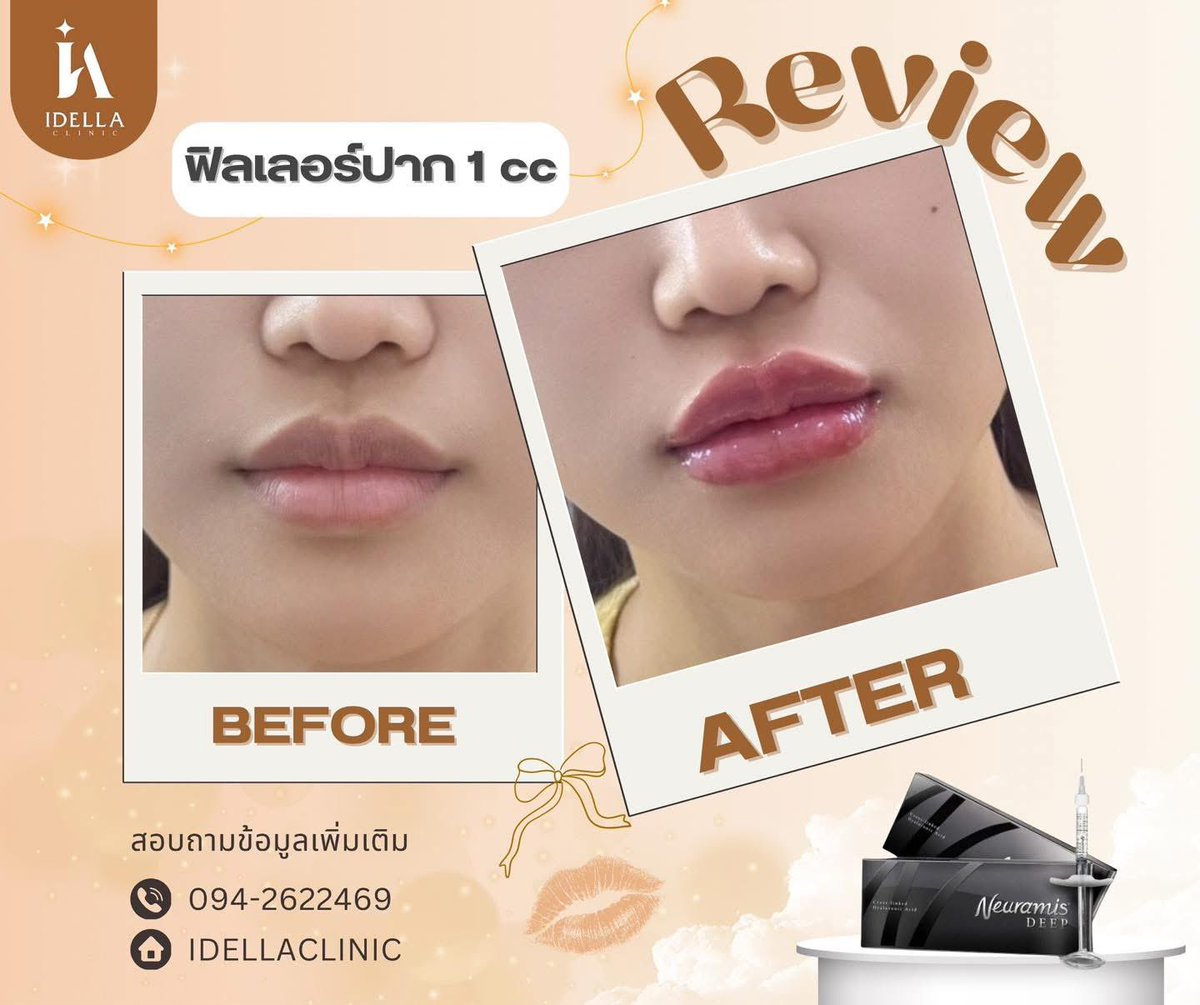 idellaclinic's tweet photo. 💋✨ #รีวิวฟิลเลอร์ปาก
อยากมีปากทรงสวย อวบอิ่ม น่าจุ๊บ ต้องดูเคสนี้เลยยย
สนใจ สอบถามข้อมูลเพิ่มเติม
♥︎⎯⎯⎯⎯⎯⎯⎯⎯⎯⎯⎯
𝗧𝗲𝗹: 𝟎𝟗𝟓-𝟐𝟔𝟐𝟐𝟒𝟔𝟗
𝗜𝗻𝗯𝗼𝘅: https://t.co/J5kl9nahbt
𝗟𝗶𝗻𝗲: https://t.co/812DEnali5
#idellaclinic #คลินิกศรีราชา #Filler https://t.co/qbI7cGi942