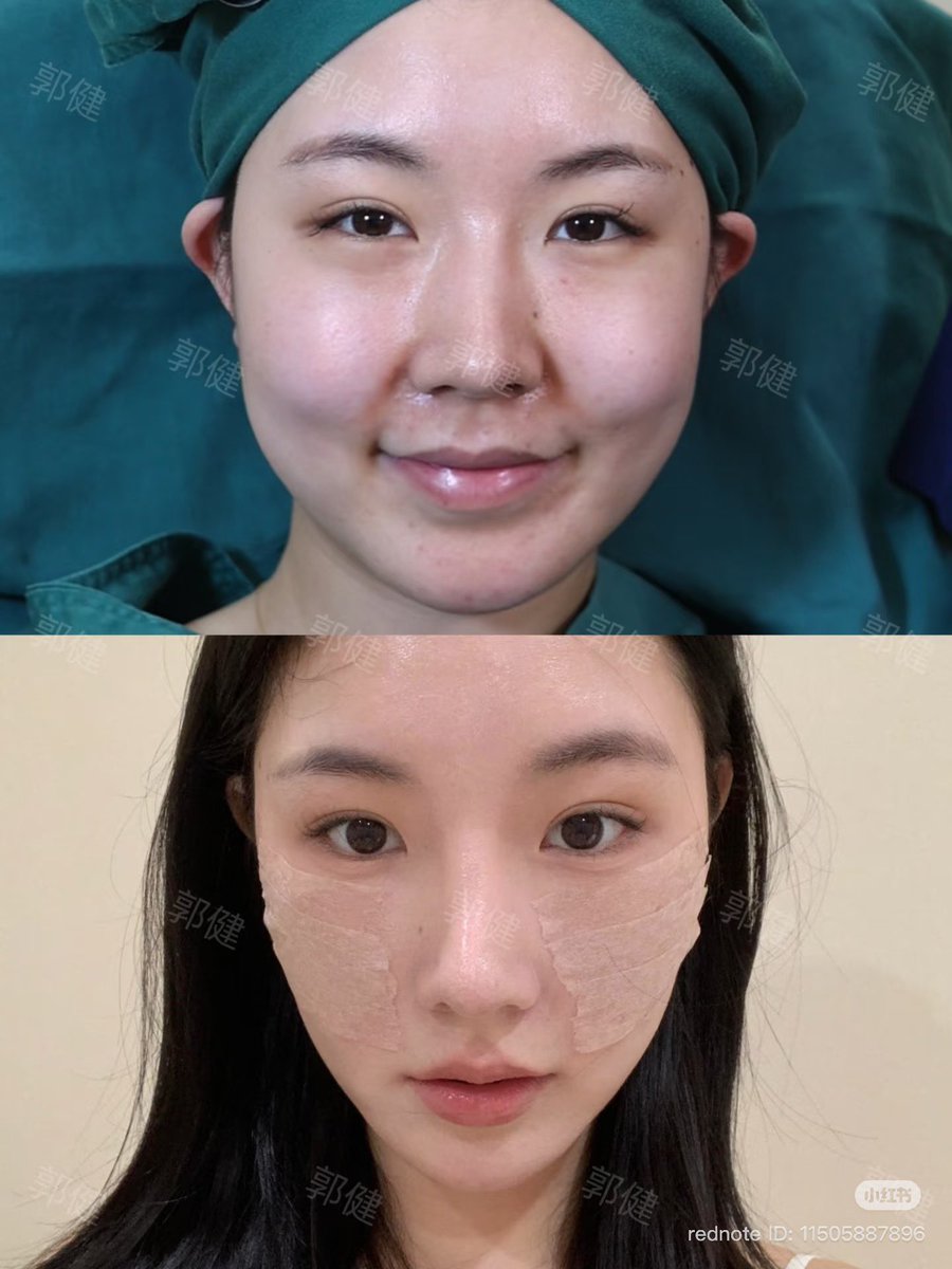 脂肪の量と頬骨の高さで余白の出方マジで変わる。
ここ整うだけで輪郭締まって、
同じパーツでも可愛さ跳ね上がるのえぐい🥹‼️