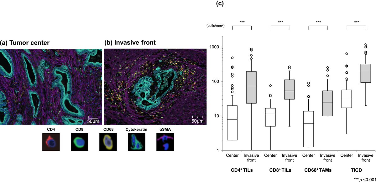 Wiley_CancerRep's tweet photo. Takahashi et al. performed retrospective analyses of cancer-specific survival in patients with stage II-III obstructive colorectal cancer. High immune cell infiltration at invasive front associates with favorable prognosis.
Full text: https://t.co/6hz5KGeayo
#Wiley #CancerReports https://t.co/fGxAPPJmo5