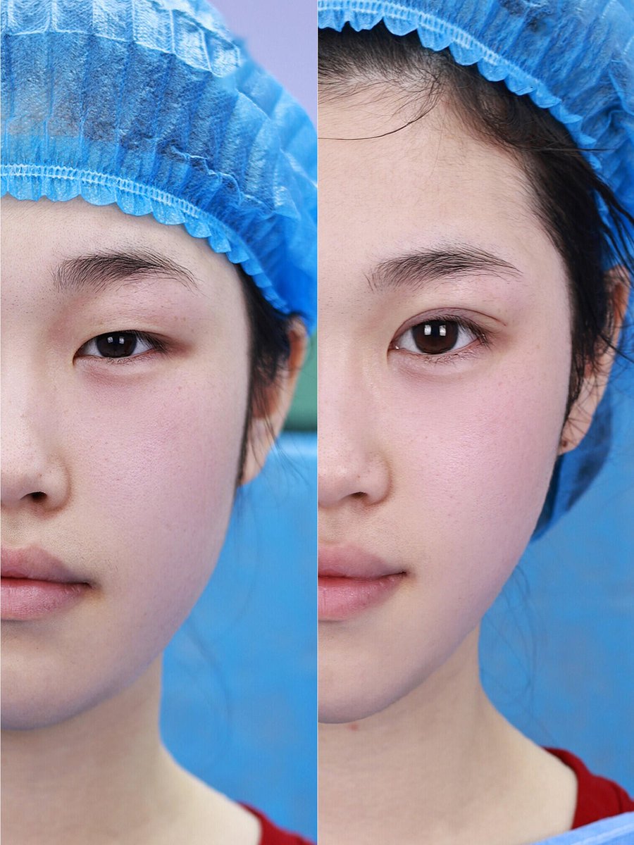 DrLeoSurgery's tweet photo. Comparison of comprehensive eye treatments 🆚 The right approach to refined eye adjustments 👉 ❌ Say no to short, round, small, lifeless, and tired eyes ✅ Smooth lines and curves 💯 7mm small slits 💕 From someone who looked like a Barbie doll with flat eyes 👀 to a goddess with stunning eyes 👀 Just one comparison of comprehensive double eyelid procedures 🆚 The aesthetics are absolutely amazing - they get the proportions just right, bringing out a "natural and lively" look right on the eyelids✨ Comparison of comprehensive eye treatment results 🆚