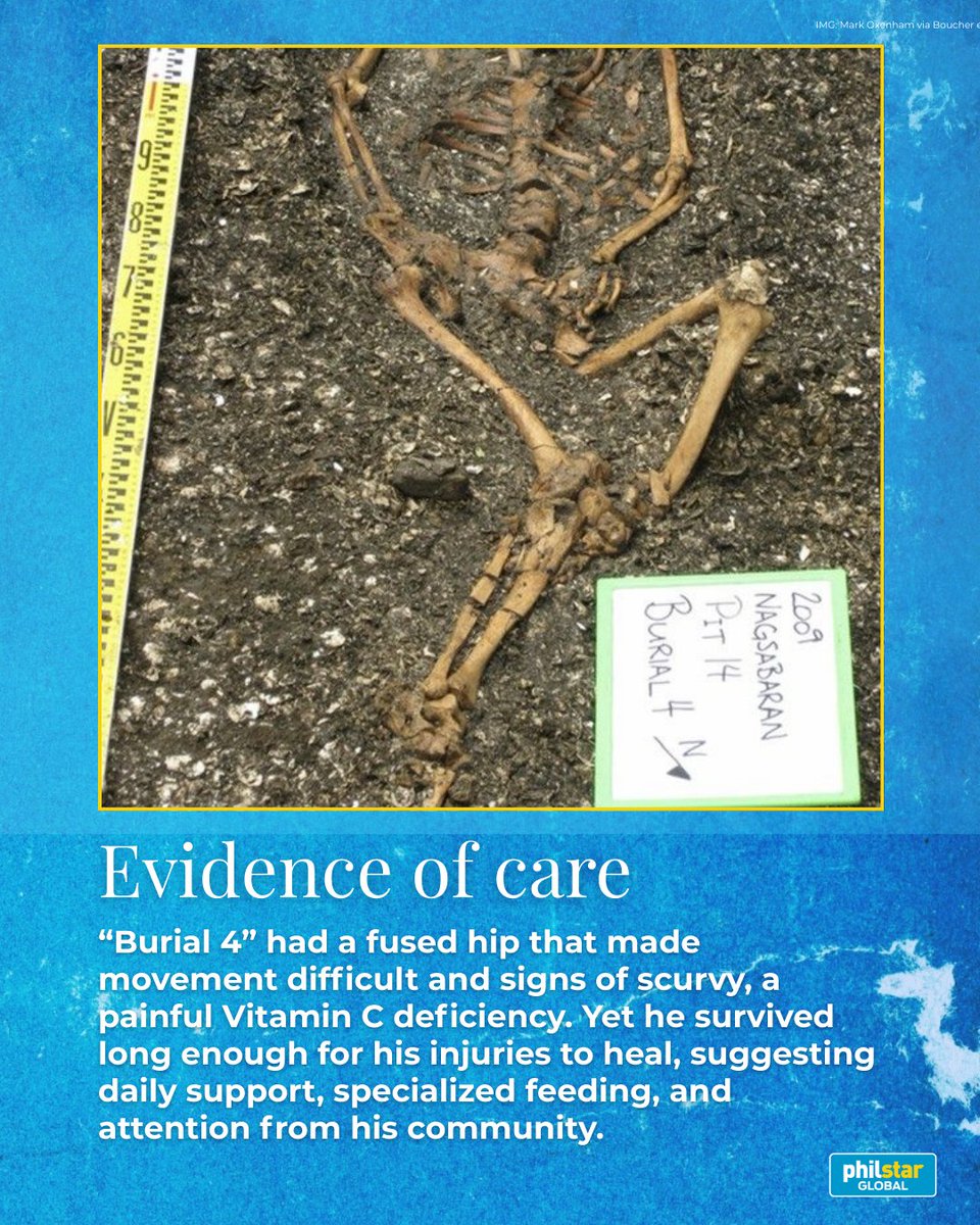 PhilstarNews's tweet photo. ANCIENT BONES REVEAL CARE IN EARLY LUZON

Long before hospitals existed, communities in what is now northern Luzon may have cared for members with disabilities.

A 2,000-year-old skeleton known as “Burial 4” shows a fused hip and signs of scurvy, yet he survived long enough for his injuries to heal — evidence that daily care and support were provided by his community. Even in death, his burial was treated differently, suggesting care extended beyond life.

Read: https://t.co/TVqVY4VFMd