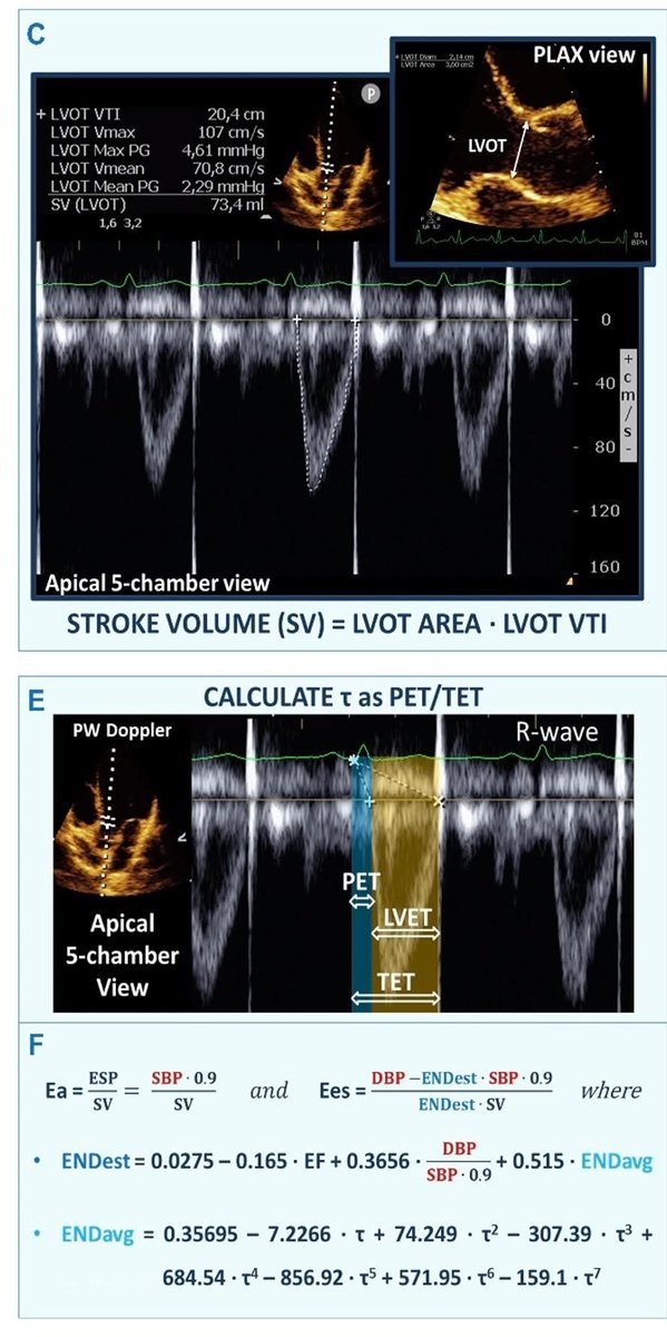 LeslieMegom's tweet photo. Por qué y cómo medir el acoplamiento ventriculo-arterial izquierdo 🫀en estados hemodinámicos rápidamente alterados.🩸
➡️Acoplamiento ventrículo-arterial izquierdo en estados hemodinámicos rápidamente cambiantes.
🎯El objetivo hemodinámico real no es subir la presión arterial sino restaurar el acoplamiento.🤓
⏺️Un paciente hipotenso puede mejorar su repndimiento cardíaco si se corrige el desacoplamiento incluso sin grandes cambios en la presión arterial media.🫀
🫀El acoplamiento ventrículo-arterial (VA coupling) describe la interacción dinámica entre la contractilidad ventricular izquierda y la carga arterial sistémica. Este concepto integra fisiología cardíaca y vascular medipante la relación entre la elastancia ventricular telesistólica (Ees) y la elastancia arterial efectiva (Ea).
🫀En el paciente crítico: En el  choque séptico, cardiogénico, post-cirugía cardíaca, ECMO o ventilación mecánica ➡️ el sistema cardiovascular experimenta cambios hemodinámicos rápidos, por lo que el análisis del acoplamiento VA permite comprender si el corazón está trabajando de manera eficiente frente a la carga vascular.
📖El modelo clásico deriva del análisis presión-volumen del ventrículo izquierdo.
🪔Relación fundamental
▪️VA coupling = Ea /Ees
🤓☝🏻Ees (End-systolic elastance)
▪️Representa la contractilidad intrínseca del ventrículo izquierdo🫀
➡️Se obtiene de la pendiente de la ESPVR (End-Systolic Pressure-Volume Relationship)
➡️Es relativamente independiente de la precarga y poscarga
🤓☝🏻Ea (Effective arterial elastance)
▪️Representa la carga arterial global
📖Integra múltiples componentes:
▪️Resistencia vascular sistémica
▪️Impedancia arterial
▪️Compliance arterial
▪️Presión arterial
Ea = ESP/SV
▪️ESP ≈ 0.9 × presión sistólica arterial
▪️SV = volumen sistólico
🎯Significado fisiológico del acoplamiento🫀
↘️Relación Ea/Ees: 
●≈ 0.5 – 1.0 Acoplamiento óptimo Máxima eficiencia energética
●  > 1 Desacoplamiento por aumento de poscarga o depresión ventricular Bajo volumen sistólico
●  < 0.5 Contractilidad excesiva respecto a carga arterial Mayor gasto energético.
🔴En condiciones normales el sistema cardiovascular se mantiene cerca del punto de máxima eficiencia energética (~0.6–0.8).
⚕️En condiciones normales el sistema cardiovascular se mantiene cerca del punto de máxima eficiencia energética (~0.6–0.8).🛜
🔰Relevancia en estados hemodinámicos dinámicos🔰
💠1. Choque séptico
↓ Ea por vasodilatación
↓ Ees por miocardiopatía séptica
→ desacoplamiento dinámico
💠2. Choque cardiogénico
↓ Ees marcado
Ea relativamente alto
→ Ea/Ees elevado (>1.5–2)
💠3. Ventilación mecánica: 
▪︎Cambios en precarga
▪︎Cambios en poscarga pulmonar y sistémica
💠ECMO o asistencia circulatoria
Cambios abruptos en poscarga ventricular
▪️1. Determinar si el problema es ventricular o vascular
Hipotensión con bajo gasto puede deberse a: Depresión ventricular (↓Ees) , exceso de poscarga (↑Ea)
▪️2. Guiar terapia vasoactiva
El efecto de fármacos puede interpretarse con el acoplamiento:
🔰Fármacos:
Norepinefrina ↑ Ea
Dobutamina ↑ Ees
Milrinona ↑ Ees + ↓ Ea
🎯La meta es restaurar un Ea/Ees cercano a 1.
▪️3. Optimizar eficiencia cardiovascular. El apcoplamiento determina: Consumo miocárdico de oxígeno, eficiencia mecánica, producción de trabajo cardíaco🫀
📖¿Cómo medirlo en la práctica clínica?
1. Método invasivo clásico (presión-volumen)
▪️Catéter conductancia ventricular
▪️Análisis presión-volumen con oclusión vena cava
Esto 0ermite calcular:
▪️ESPVR
▪️Ees real
Pero no es práctico en UCI.
2. Estimación clínica simplificada
▪️Método más utilizado:
Calcular Ea.
PAS = presión arterial sistólica
SV = volumen sistólico (eco o monitor hemodinámico)
🎯El objetivo hemodinámico real no es subir la presión arterial sino restaurar el acoplamiento.
🫀Un paciente hipotenso puede mejorar su rendimiento cardíaco si se corrige el desacoplamiento incluso sin grandes cambios en la presión arterial media.
👇🏽👇🏽👇🏽👇🏽