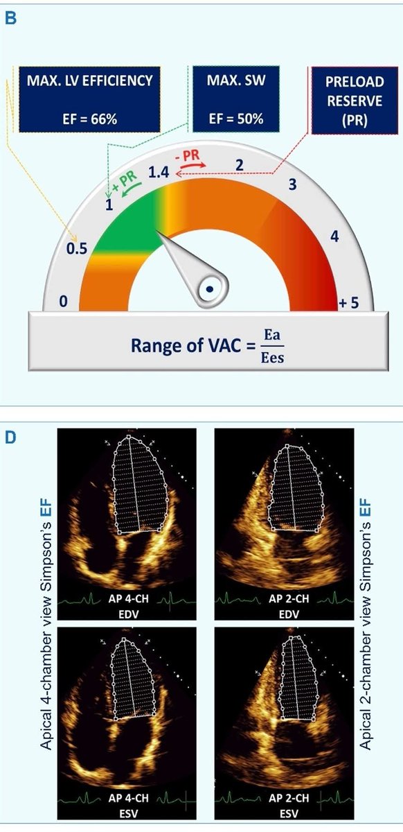 LeslieMegom's tweet photo. Por qué y cómo medir el acoplamiento ventriculo-arterial izquierdo 🫀en estados hemodinámicos rápidamente alterados.🩸
➡️Acoplamiento ventrículo-arterial izquierdo en estados hemodinámicos rápidamente cambiantes.
🎯El objetivo hemodinámico real no es subir la presión arterial sino restaurar el acoplamiento.🤓
⏺️Un paciente hipotenso puede mejorar su repndimiento cardíaco si se corrige el desacoplamiento incluso sin grandes cambios en la presión arterial media.🫀
🫀El acoplamiento ventrículo-arterial (VA coupling) describe la interacción dinámica entre la contractilidad ventricular izquierda y la carga arterial sistémica. Este concepto integra fisiología cardíaca y vascular medipante la relación entre la elastancia ventricular telesistólica (Ees) y la elastancia arterial efectiva (Ea).
🫀En el paciente crítico: En el  choque séptico, cardiogénico, post-cirugía cardíaca, ECMO o ventilación mecánica ➡️ el sistema cardiovascular experimenta cambios hemodinámicos rápidos, por lo que el análisis del acoplamiento VA permite comprender si el corazón está trabajando de manera eficiente frente a la carga vascular.
📖El modelo clásico deriva del análisis presión-volumen del ventrículo izquierdo.
🪔Relación fundamental
▪️VA coupling = Ea /Ees
🤓☝🏻Ees (End-systolic elastance)
▪️Representa la contractilidad intrínseca del ventrículo izquierdo🫀
➡️Se obtiene de la pendiente de la ESPVR (End-Systolic Pressure-Volume Relationship)
➡️Es relativamente independiente de la precarga y poscarga
🤓☝🏻Ea (Effective arterial elastance)
▪️Representa la carga arterial global
📖Integra múltiples componentes:
▪️Resistencia vascular sistémica
▪️Impedancia arterial
▪️Compliance arterial
▪️Presión arterial
Ea = ESP/SV
▪️ESP ≈ 0.9 × presión sistólica arterial
▪️SV = volumen sistólico
🎯Significado fisiológico del acoplamiento🫀
↘️Relación Ea/Ees: 
●≈ 0.5 – 1.0 Acoplamiento óptimo Máxima eficiencia energética
●  > 1 Desacoplamiento por aumento de poscarga o depresión ventricular Bajo volumen sistólico
●  < 0.5 Contractilidad excesiva respecto a carga arterial Mayor gasto energético.
🔴En condiciones normales el sistema cardiovascular se mantiene cerca del punto de máxima eficiencia energética (~0.6–0.8).
⚕️En condiciones normales el sistema cardiovascular se mantiene cerca del punto de máxima eficiencia energética (~0.6–0.8).🛜
🔰Relevancia en estados hemodinámicos dinámicos🔰
💠1. Choque séptico
↓ Ea por vasodilatación
↓ Ees por miocardiopatía séptica
→ desacoplamiento dinámico
💠2. Choque cardiogénico
↓ Ees marcado
Ea relativamente alto
→ Ea/Ees elevado (>1.5–2)
💠3. Ventilación mecánica: 
▪︎Cambios en precarga
▪︎Cambios en poscarga pulmonar y sistémica
💠ECMO o asistencia circulatoria
Cambios abruptos en poscarga ventricular
▪️1. Determinar si el problema es ventricular o vascular
Hipotensión con bajo gasto puede deberse a: Depresión ventricular (↓Ees) , exceso de poscarga (↑Ea)
▪️2. Guiar terapia vasoactiva
El efecto de fármacos puede interpretarse con el acoplamiento:
🔰Fármacos:
Norepinefrina ↑ Ea
Dobutamina ↑ Ees
Milrinona ↑ Ees + ↓ Ea
🎯La meta es restaurar un Ea/Ees cercano a 1.
▪️3. Optimizar eficiencia cardiovascular. El apcoplamiento determina: Consumo miocárdico de oxígeno, eficiencia mecánica, producción de trabajo cardíaco🫀
📖¿Cómo medirlo en la práctica clínica?
1. Método invasivo clásico (presión-volumen)
▪️Catéter conductancia ventricular
▪️Análisis presión-volumen con oclusión vena cava
Esto 0ermite calcular:
▪️ESPVR
▪️Ees real
Pero no es práctico en UCI.
2. Estimación clínica simplificada
▪️Método más utilizado:
Calcular Ea.
PAS = presión arterial sistólica
SV = volumen sistólico (eco o monitor hemodinámico)
🎯El objetivo hemodinámico real no es subir la presión arterial sino restaurar el acoplamiento.
🫀Un paciente hipotenso puede mejorar su rendimiento cardíaco si se corrige el desacoplamiento incluso sin grandes cambios en la presión arterial media.
👇🏽👇🏽👇🏽👇🏽
