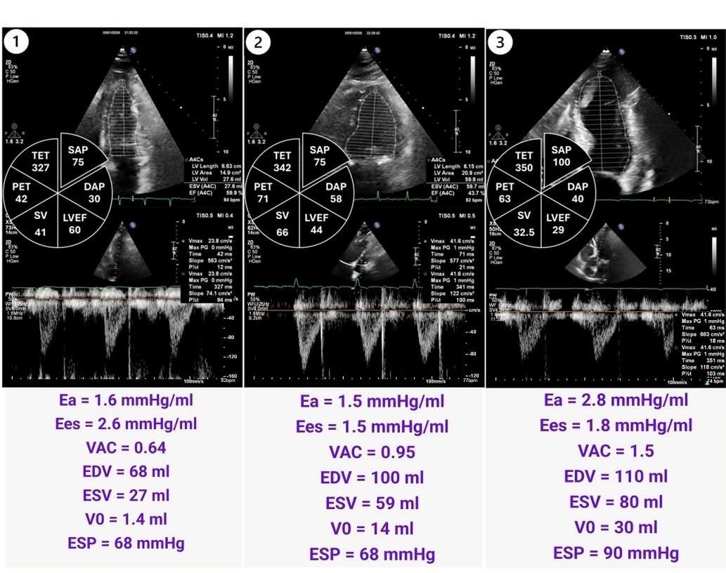 LeslieMegom's tweet photo. Por qué y cómo medir el acoplamiento ventriculo-arterial izquierdo 🫀en estados hemodinámicos rápidamente alterados.🩸
➡️Acoplamiento ventrículo-arterial izquierdo en estados hemodinámicos rápidamente cambiantes.
🎯El objetivo hemodinámico real no es subir la presión arterial sino restaurar el acoplamiento.🤓
⏺️Un paciente hipotenso puede mejorar su repndimiento cardíaco si se corrige el desacoplamiento incluso sin grandes cambios en la presión arterial media.🫀
🫀El acoplamiento ventrículo-arterial (VA coupling) describe la interacción dinámica entre la contractilidad ventricular izquierda y la carga arterial sistémica. Este concepto integra fisiología cardíaca y vascular medipante la relación entre la elastancia ventricular telesistólica (Ees) y la elastancia arterial efectiva (Ea).
🫀En el paciente crítico: En el  choque séptico, cardiogénico, post-cirugía cardíaca, ECMO o ventilación mecánica ➡️ el sistema cardiovascular experimenta cambios hemodinámicos rápidos, por lo que el análisis del acoplamiento VA permite comprender si el corazón está trabajando de manera eficiente frente a la carga vascular.
📖El modelo clásico deriva del análisis presión-volumen del ventrículo izquierdo.
🪔Relación fundamental
▪️VA coupling = Ea /Ees
🤓☝🏻Ees (End-systolic elastance)
▪️Representa la contractilidad intrínseca del ventrículo izquierdo🫀
➡️Se obtiene de la pendiente de la ESPVR (End-Systolic Pressure-Volume Relationship)
➡️Es relativamente independiente de la precarga y poscarga
🤓☝🏻Ea (Effective arterial elastance)
▪️Representa la carga arterial global
📖Integra múltiples componentes:
▪️Resistencia vascular sistémica
▪️Impedancia arterial
▪️Compliance arterial
▪️Presión arterial
Ea = ESP/SV
▪️ESP ≈ 0.9 × presión sistólica arterial
▪️SV = volumen sistólico
🎯Significado fisiológico del acoplamiento🫀
↘️Relación Ea/Ees: 
●≈ 0.5 – 1.0 Acoplamiento óptimo Máxima eficiencia energética
●  > 1 Desacoplamiento por aumento de poscarga o depresión ventricular Bajo volumen sistólico
●  < 0.5 Contractilidad excesiva respecto a carga arterial Mayor gasto energético.
🔴En condiciones normales el sistema cardiovascular se mantiene cerca del punto de máxima eficiencia energética (~0.6–0.8).
⚕️En condiciones normales el sistema cardiovascular se mantiene cerca del punto de máxima eficiencia energética (~0.6–0.8).🛜
🔰Relevancia en estados hemodinámicos dinámicos🔰
💠1. Choque séptico
↓ Ea por vasodilatación
↓ Ees por miocardiopatía séptica
→ desacoplamiento dinámico
💠2. Choque cardiogénico
↓ Ees marcado
Ea relativamente alto
→ Ea/Ees elevado (>1.5–2)
💠3. Ventilación mecánica: 
▪︎Cambios en precarga
▪︎Cambios en poscarga pulmonar y sistémica
💠ECMO o asistencia circulatoria
Cambios abruptos en poscarga ventricular
▪️1. Determinar si el problema es ventricular o vascular
Hipotensión con bajo gasto puede deberse a: Depresión ventricular (↓Ees) , exceso de poscarga (↑Ea)
▪️2. Guiar terapia vasoactiva
El efecto de fármacos puede interpretarse con el acoplamiento:
🔰Fármacos:
Norepinefrina ↑ Ea
Dobutamina ↑ Ees
Milrinona ↑ Ees + ↓ Ea
🎯La meta es restaurar un Ea/Ees cercano a 1.
▪️3. Optimizar eficiencia cardiovascular. El apcoplamiento determina: Consumo miocárdico de oxígeno, eficiencia mecánica, producción de trabajo cardíaco🫀
📖¿Cómo medirlo en la práctica clínica?
1. Método invasivo clásico (presión-volumen)
▪️Catéter conductancia ventricular
▪️Análisis presión-volumen con oclusión vena cava
Esto 0ermite calcular:
▪️ESPVR
▪️Ees real
Pero no es práctico en UCI.
2. Estimación clínica simplificada
▪️Método más utilizado:
Calcular Ea.
PAS = presión arterial sistólica
SV = volumen sistólico (eco o monitor hemodinámico)
🎯El objetivo hemodinámico real no es subir la presión arterial sino restaurar el acoplamiento.
🫀Un paciente hipotenso puede mejorar su rendimiento cardíaco si se corrige el desacoplamiento incluso sin grandes cambios en la presión arterial media.
👇🏽👇🏽👇🏽👇🏽