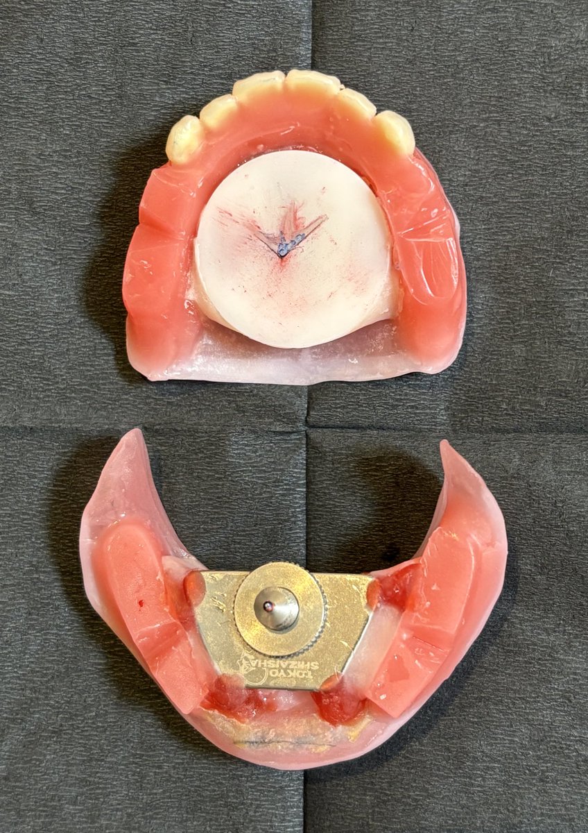 これだけタッピングがバラつくとさすがにゴシックアーチが良い仕事してるってなるよね👀
前の義歯合わなくて5ヶ月くらい使ってないみたいだからこれは予想はしてたけど。
でも思ったより↓は上手く描けてて良き🫶