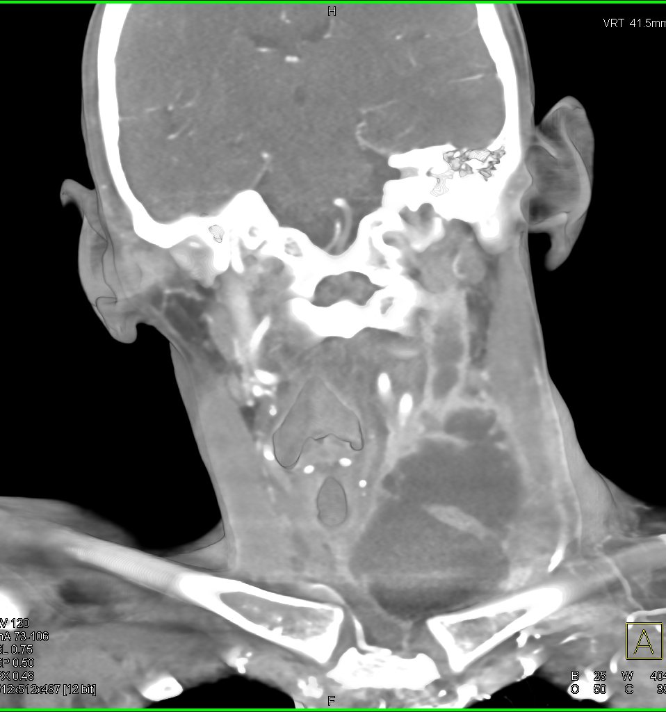 Elliot K Fishman / CTisus.com tweet media