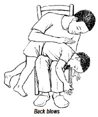 AldhitamaR's tweet photo. Memposisikan anak tersedak dibedakan berdasarkan usia. 

Untuk bayi (<1 tahun): tengkurapkan di lengan/paha (kepala lebih rendah) untuk back blows (pukul punggung) atau telentang untuk chest thrust (tekan dada). 

Untuk anak (>1 tahun): peluk dari belakang (posisi berdiri/duduk) untuk abdominal thrust(hentakan perut/Heimlich manuver).

Harus adekuat ya, gausah takut takut.

Jangan pernah melakukan blind finger sweep (memasukkan jari ke mulut tanpa melihat objek) karena bisa mendorong benda lebih dalam.

Jika anak masih bisa batuk kuat, biarkan dia batuk dan jangan lakukan manuver apa pun.

Segera cari pertolongan medis jika anak pingsan atau benda asing tidak kunjung keluar.