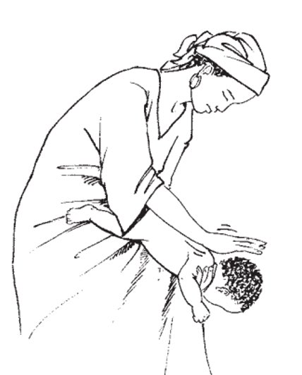 AldhitamaR's tweet photo. Memposisikan anak tersedak dibedakan berdasarkan usia. 

Untuk bayi (<1 tahun): tengkurapkan di lengan/paha (kepala lebih rendah) untuk back blows (pukul punggung) atau telentang untuk chest thrust (tekan dada). 

Untuk anak (>1 tahun): peluk dari belakang (posisi berdiri/duduk) untuk abdominal thrust(hentakan perut/Heimlich manuver).

Harus adekuat ya, gausah takut takut.

Jangan pernah melakukan blind finger sweep (memasukkan jari ke mulut tanpa melihat objek) karena bisa mendorong benda lebih dalam.

Jika anak masih bisa batuk kuat, biarkan dia batuk dan jangan lakukan manuver apa pun.

Segera cari pertolongan medis jika anak pingsan atau benda asing tidak kunjung keluar.