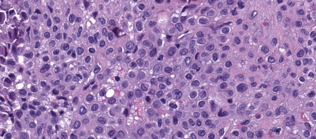 JMGardnerMD's tweet photo. 12 yo M with 3 cm prox tibia epiphyseal lytic bone lesion, demarcated w sclerotic rim.
Answer ✅ https://t.co/oc8zx7iPcF
WSI digital slide: https://t.co/FI5aNFDO5S.
#BSTpath #radpathmatch #radiology #pathology #pathTwitter #orthotwitter https://t.co/OQrMwkQA8z
