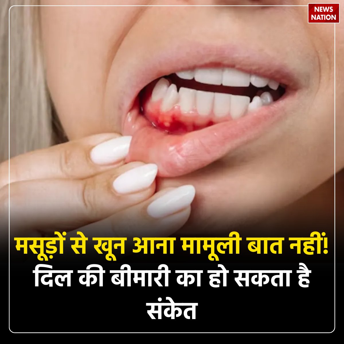 NewsNationTV's tweet photo. मसूड़ों से खून आना मामूली बात नहीं! दिल की बीमारी का हो सकता है संकेत
पूरी खबर पढ़ें: https://t.co/OvhTsR4Lml
#HealthAlert #GumBleeding #OralHealth #HeartDisease #HealthWarning #DentalCare #HealthyLiving https://t.co/DjHi17G5yD
