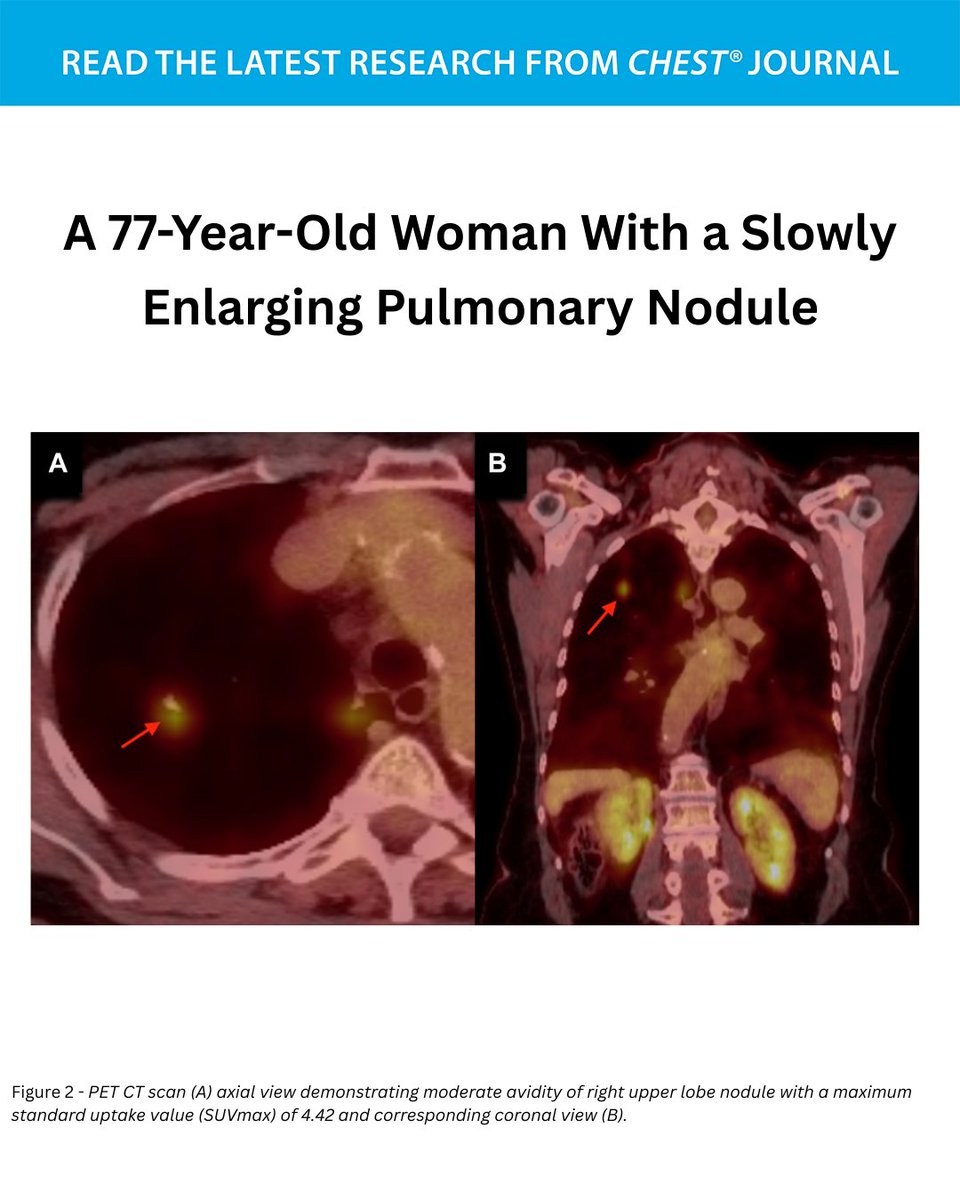 CHEST® Journal tweet media