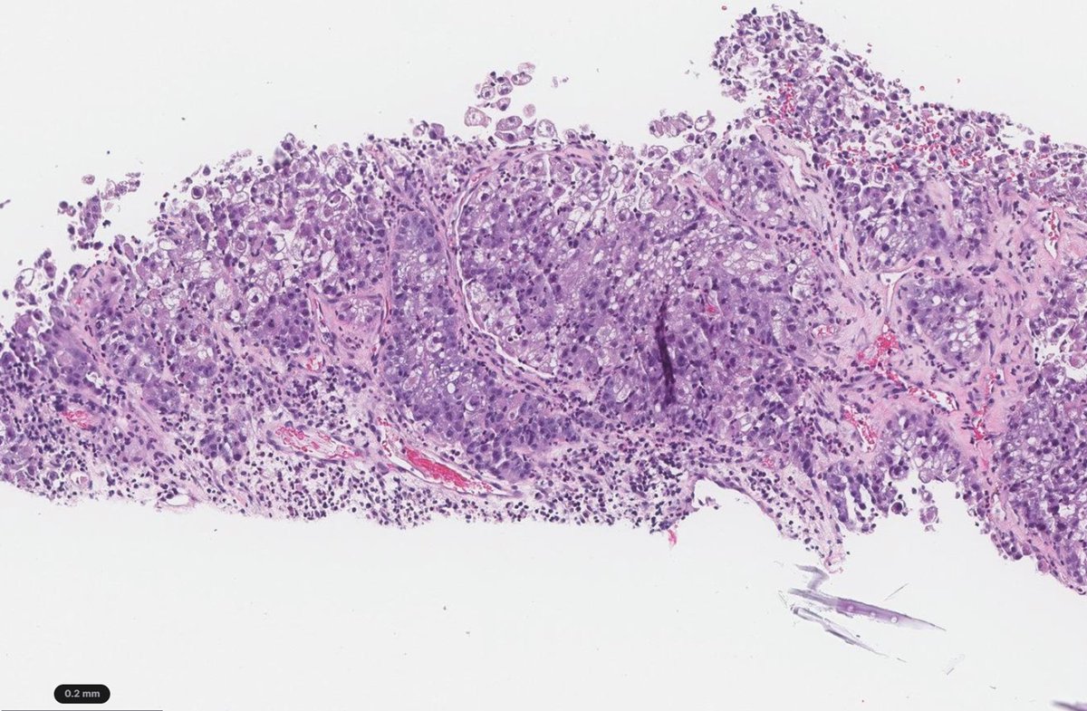 Natasha Rekhtman MD PhD tweet media