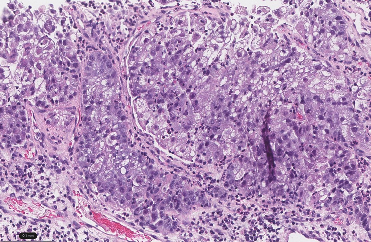 Natasha Rekhtman MD PhD tweet media