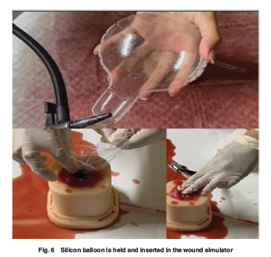 ASMEJournals's tweet image. The innovation of a portable device to stop limbs external bleeding. asmedigitalcollection.asme.org/medicaldevices…
#medicaldevice