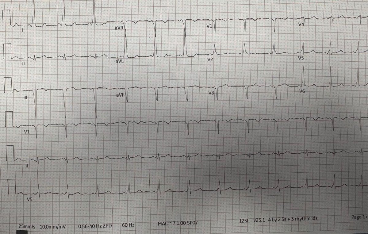 _lamaalharbi's tweet image. A young  female patient in the 30s with ECG showing Delta Waves, Short PR interval, slightly wide QRS on The ECG mainly in V6-V5 but also present at the end of V2 . We offerred referral to electrophysiological study Incidental finding of Wolf Parkinson White Syndrome #WPW #ECG