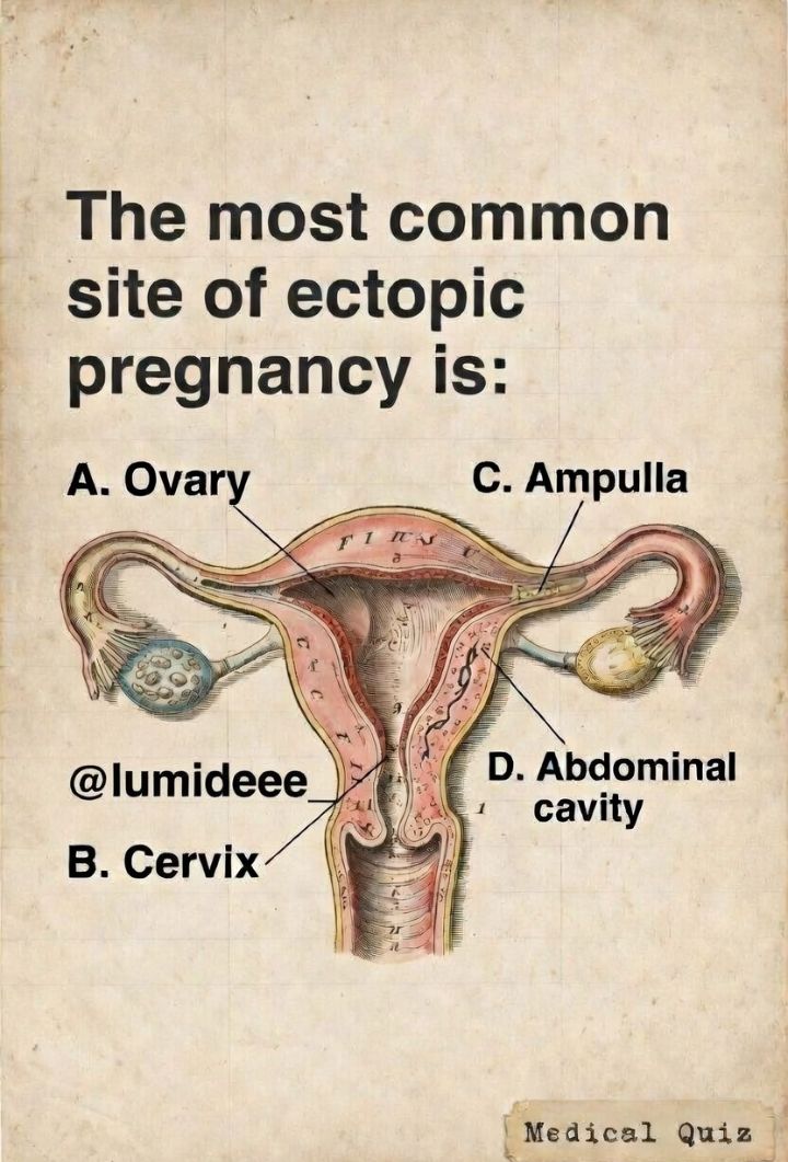 Lumideee_'s tweet image. The most common site of ectopic pregnancy is:
A. Ovary
B. Cervix
C. Ampulla
D. Abdominal cavity

Save this for your revision 📌
#OBGYN #MedTwitter #MedicalQuiz #MedStudent #USMLE #PLAB
