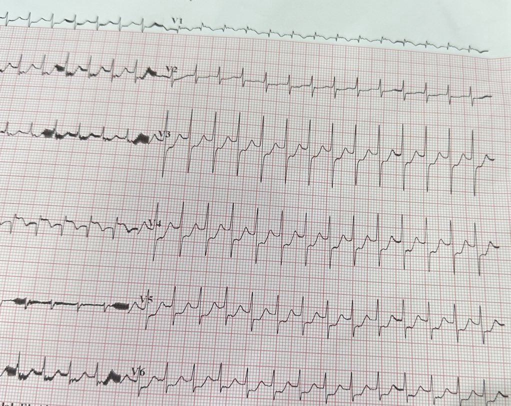 _lamaalharbi's tweet photo. A case of a 54 year old man with supraventricular tachycardia and a pulse of 140-160 and stable BP and Oxygen Sat. and in a conscious level after which I did carotid massage for TWO MINUTES and The Pulse Came Back To Normal Range 68-75 #SaveLives #ECG #Medicine https://t.co/xvNWuhoIdh