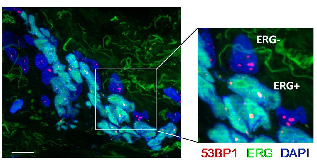 jclinicalinvest's tweet image. Facilitating precision therapy in #ProstateCancer… 

doi.org/10.1172/JCI194… 
Wael Y. Mansour &amp;amp; team @UKEHamburg discover ERG overexpression as a biomarker for identifying patients with prostate cancer who can benefit from #PARPi-based radiosensitization, enhancing radiotherapy