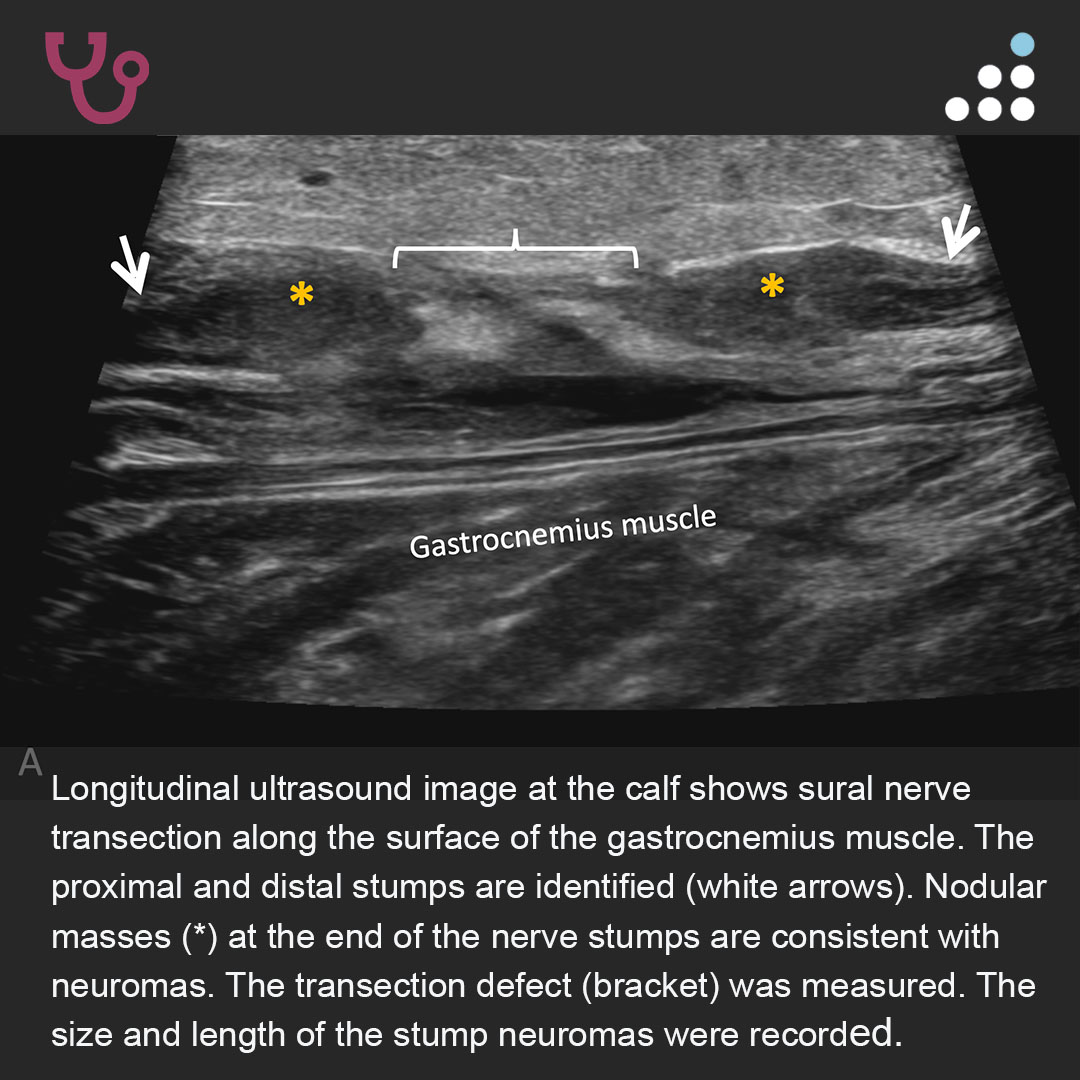 orthobullets's tweet photo. Here is a new case by Dr. O. Kenechi Nwawka and Hospital for Special Surgery @HSpecialSurgery.

LATERAL FOOT NUMBNESS S/P GASTROCNEMIUS RECESSION IN 59F

Imaging techniques will be discussed at the HSS Musculoskeletal Ultrasound Course 2026 in New York, NY, April 17-18, 2026.

How would you manage this #orthotwitter?

Vote on this case for CME: https://t.co/DHTsOz7KYp