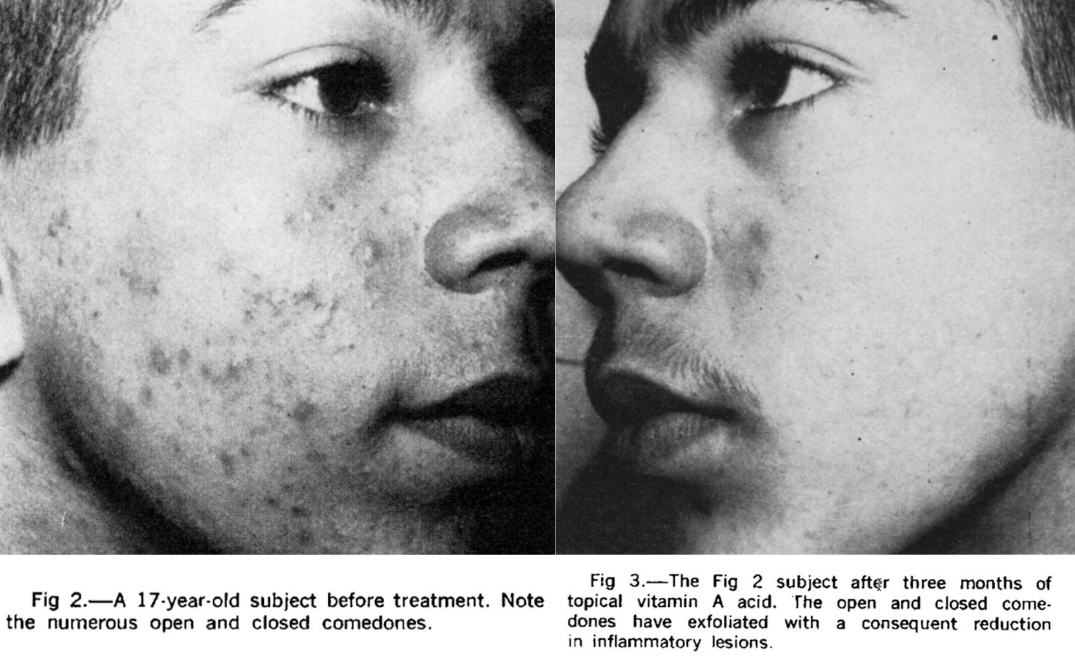 lowmegatron's tweet photo. Ray Peat found thyroid hormone and vitamin A improved acne, bladder infection, kidney infections, periodontitis, and sinusitis.

“Beginning in 1973, a clinic in Eugene, Oregon (a city which is notorious for allergies, because of the surrounding grass-seed farms which produce pollen in the spring, and smoke from field-burning in the summer and fall) had very good results with their allergy patients when they gave them supplements of vitamin A, pantothenic acid, and vitamin C. 

Later, thyroid extract, or thyroid hormone T3 and magnesium were added to the other supplements for patients who had problems more serious than ordinary allergies. We found that many people with acne, bladder or kidney infections, periodontitis and sinusitis seemed to be deficient in both thyroid and vitamin A even when they were taking supplements of those materials. At higher doses of both, many of those people quickly got over their infections. Many people with colitis, myositis, bursitis and arthritis had sudden relief from their symptoms on this, or a similar program. We have assumed that some toxin might be interfering with the biological effects of thyroid and vitamin A.”

Ref 
Repairing Immunodeficiencies Townsend Letter for Doctors, November, 1989
Topical Vitamin A Acid in Acne Vulgaris