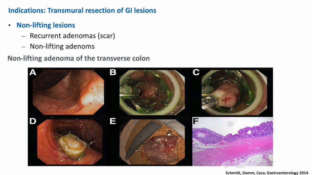 EndoCollab™ | GI Endoscopy Community tweet media