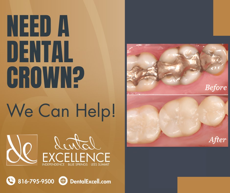dntexcell's tweet photo. A dental crown is a custom-made “cap” placed over a damaged or weakened tooth to restore its strength, shape, and appearance. Crowns are often used for teeth that are cracked, worn down, or have large fillings. https://t.co/9yqjVZhMaP