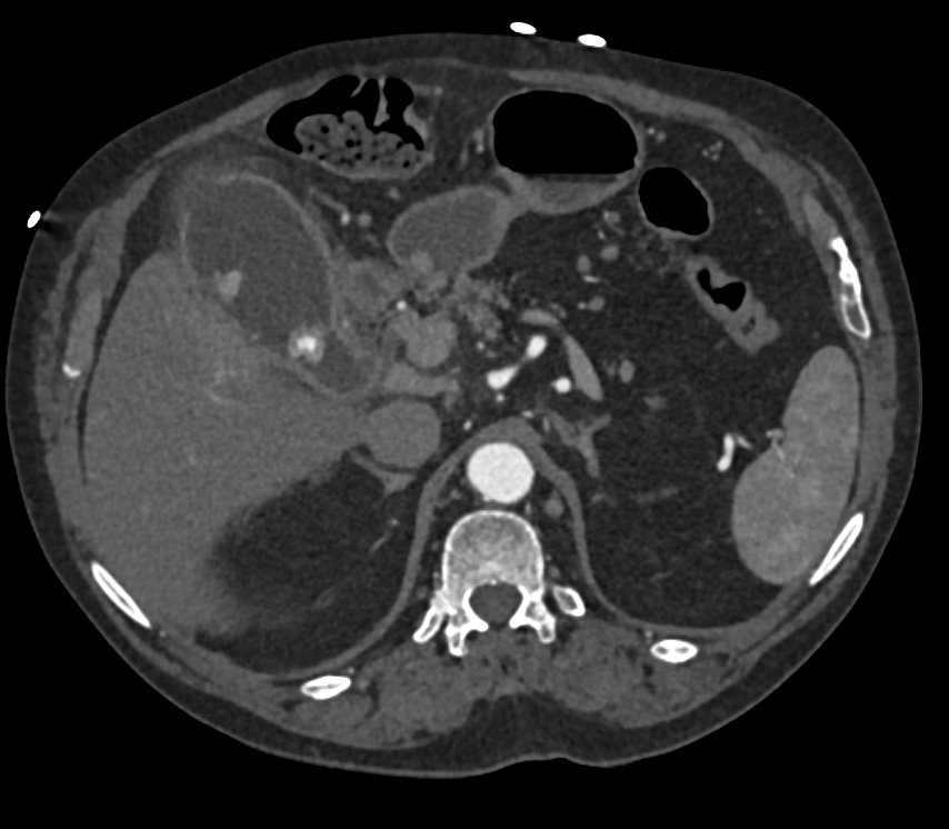 Elliot K Fishman / CTisus.com tweet media