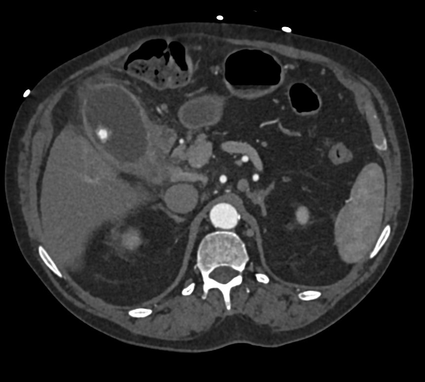 Elliot K Fishman / CTisus.com tweet media