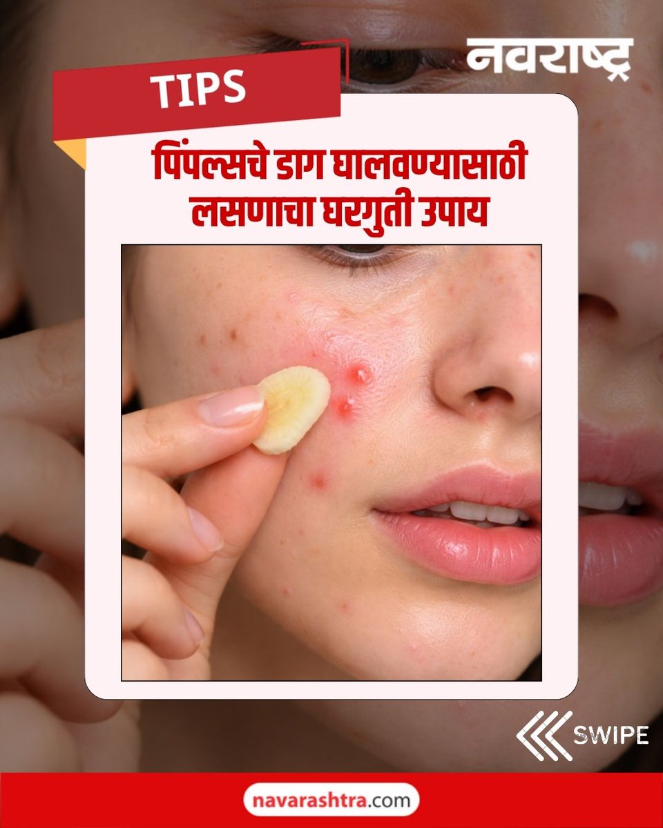 navarashtra's tweet image. चेहऱ्यावर पिंपल्स येतात आणि जातात, महागड्या क्रिम्सऐवजी लसणाचा  हा घरगुती उपाय वापरून पहा...
( लसूण थेट त्वचेवर लावण्यापूर्वी 'पॅच टेस्ट' नक्की करा, जर तुमची त्वचा संवेदनशील असेल, तर लसूण वापरणे टाळा किंवा डॉक्टरांचा सल्ला घ्या. )
#GarlicBenefits #PimpleRemedy #SkinCareTips