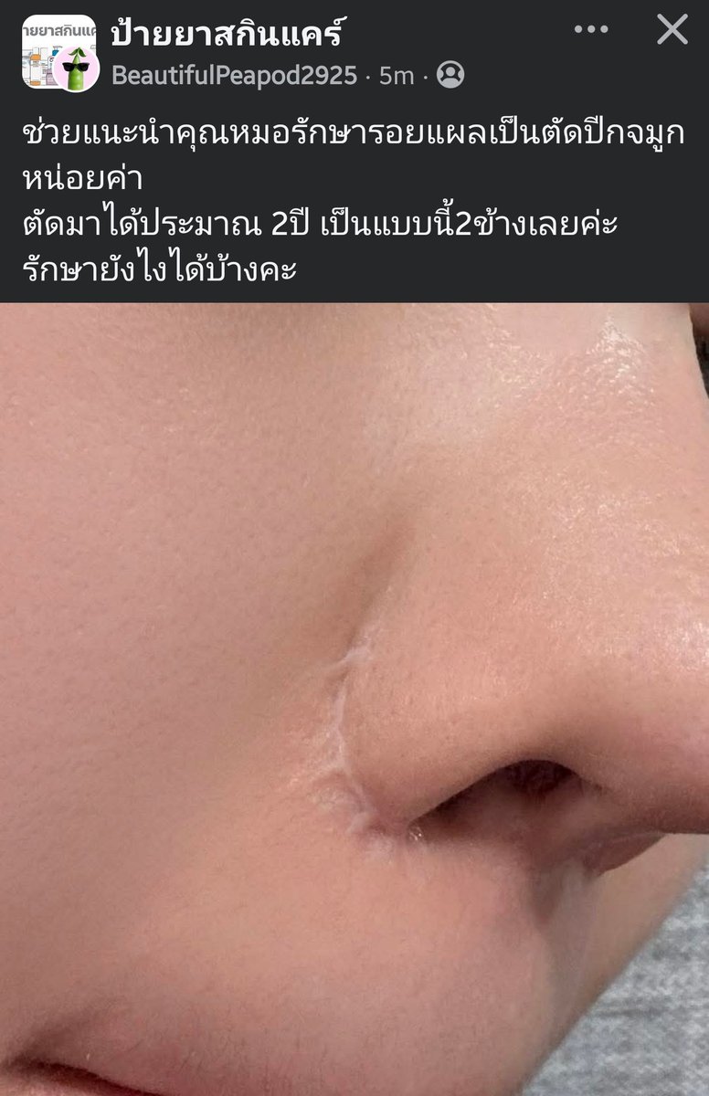 ploypuanggg's tweet photo. สงสัยเรื่องตัดปีกจมูกมานานแล้วว่าทำไมบางคนก็ไม่มีรอยแผลเป็นเลยคือมันมีปัจจัยอะไรพิเศษเป็นเพราะเทคนิคหมอแต่ละคนหรือจริงๆรอยแผลเป็นแค่เฉพาะคนที่มีคีลอยด์ง่ายอยู่ก่อนแล้วแค่นั้น https://t.co/heUhOrNKTD