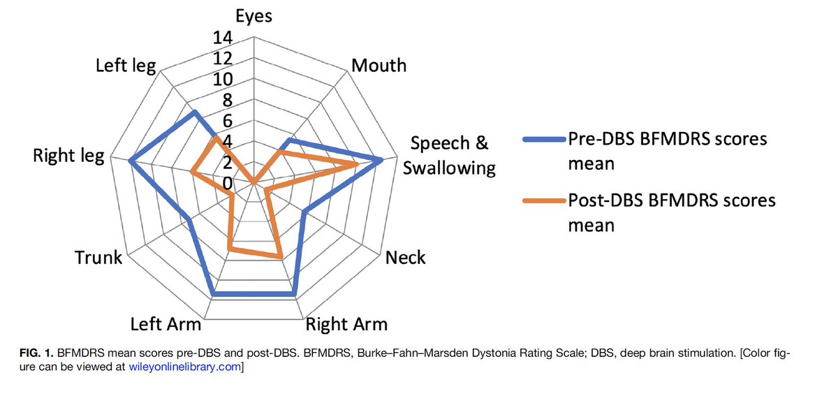 MDJ_Journal's tweet photo. Recognizing which genetic dystonias are responsive to DBS is essential. In Woodhouse–Sakati syndrome, Alhodaif et al. evaluated five patients and reported an approximate 39% improvement in BFMDRS scores following bilateral GPi DBS. https://t.co/CLjXNnrROk https://t.co/FMRJc9FmWc