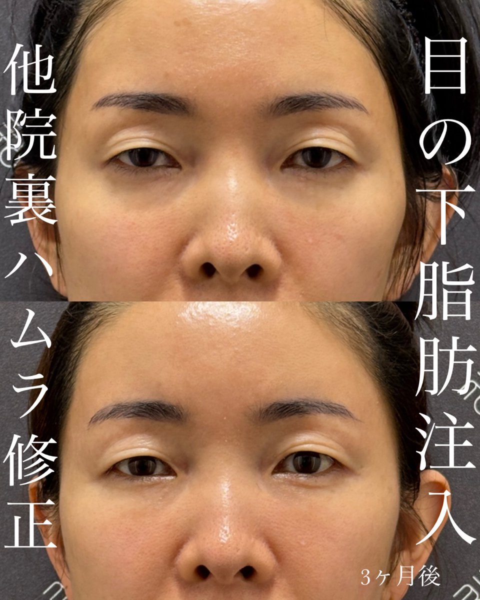 なおき先生👨‍⚕️クマ脂肪注入専門 tweet media