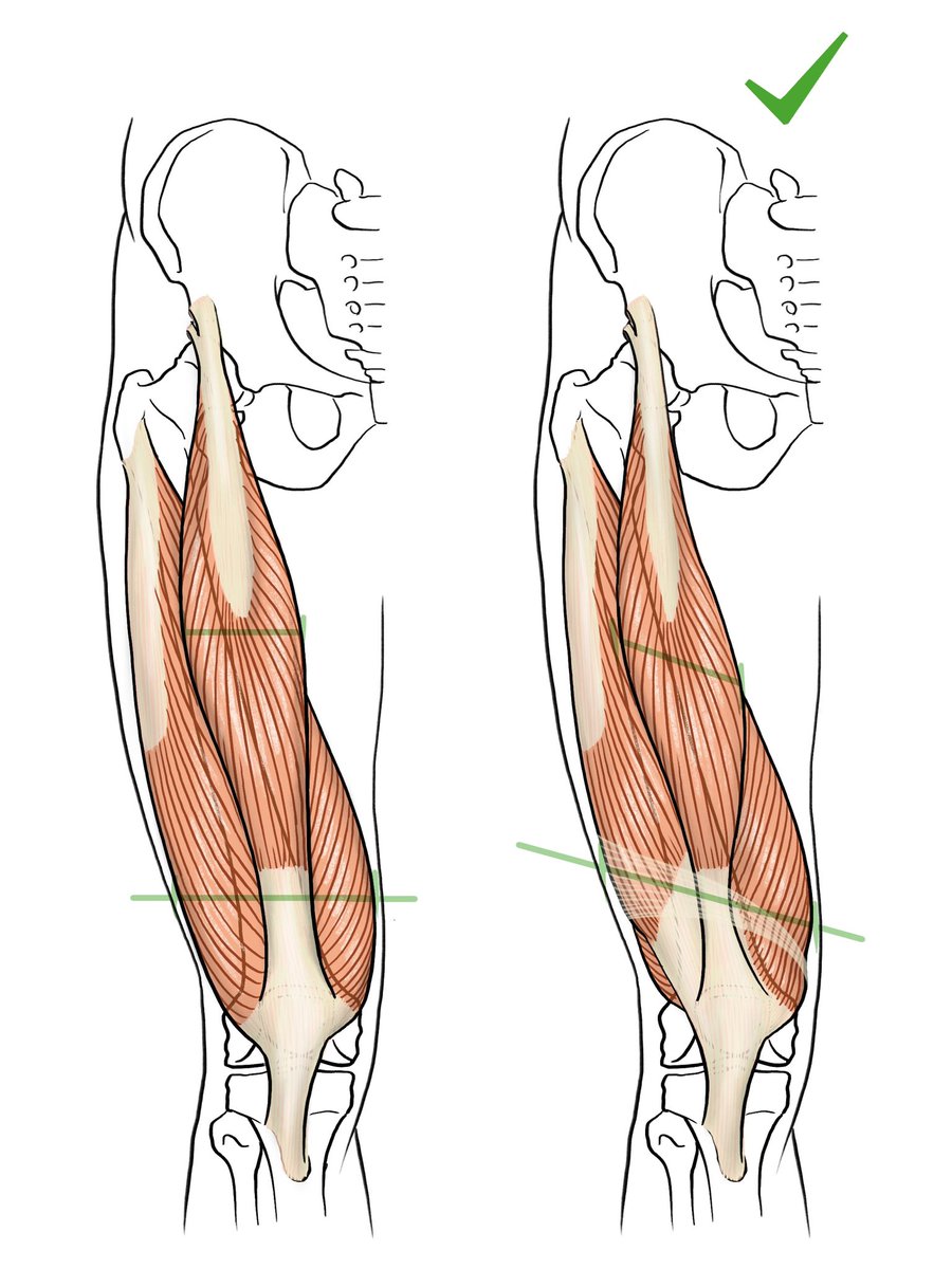kato_anatomy's tweet photo. ふとももの膨らみをつくる筋肉の傾斜 https://t.co/GMI4HADPt8
