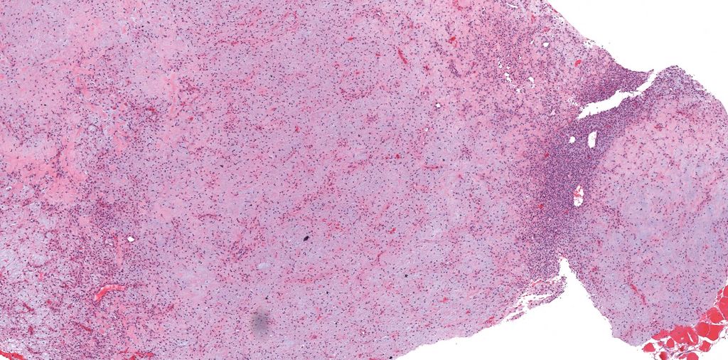 JMGardnerMD's tweet image. 20 yo M w/ 5 cm lytic bone lesion in proximal tibia metaphysis, sharply demarcated w/ sclerotic rim. 
Answer ✅ youtu.be/LIY3jatGjv4?si…
Digital slide: kikoxp.com/posts/4606. 
#BSTpath #radpathmatch #radiology #pathology #pathTwitter #orthotwitter