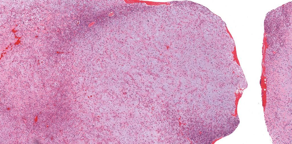 JMGardnerMD's tweet image. 20 yo M w/ 5 cm lytic bone lesion in proximal tibia metaphysis, sharply demarcated w/ sclerotic rim. 
Answer ✅ youtu.be/LIY3jatGjv4?si…
Digital slide: kikoxp.com/posts/4606. 
#BSTpath #radpathmatch #radiology #pathology #pathTwitter #orthotwitter