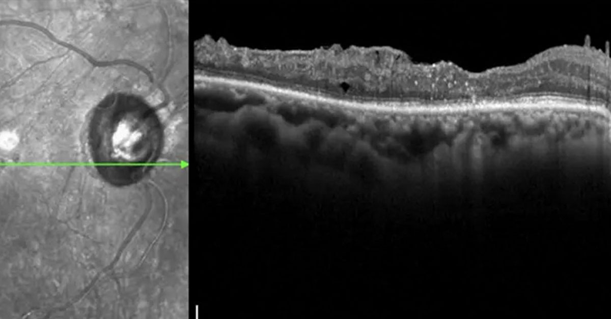 aao_ophth's tweet image. How are you choosing anti-VEGF therapies for patients with DME? 

Start this 30-minute #CME course to hear Diana Do, MD, and David Boyer, MD, share the clinical factors that guide their treatment decisions: ow.ly/FZPr50YqwrK 

#AAO #Ophthalmology