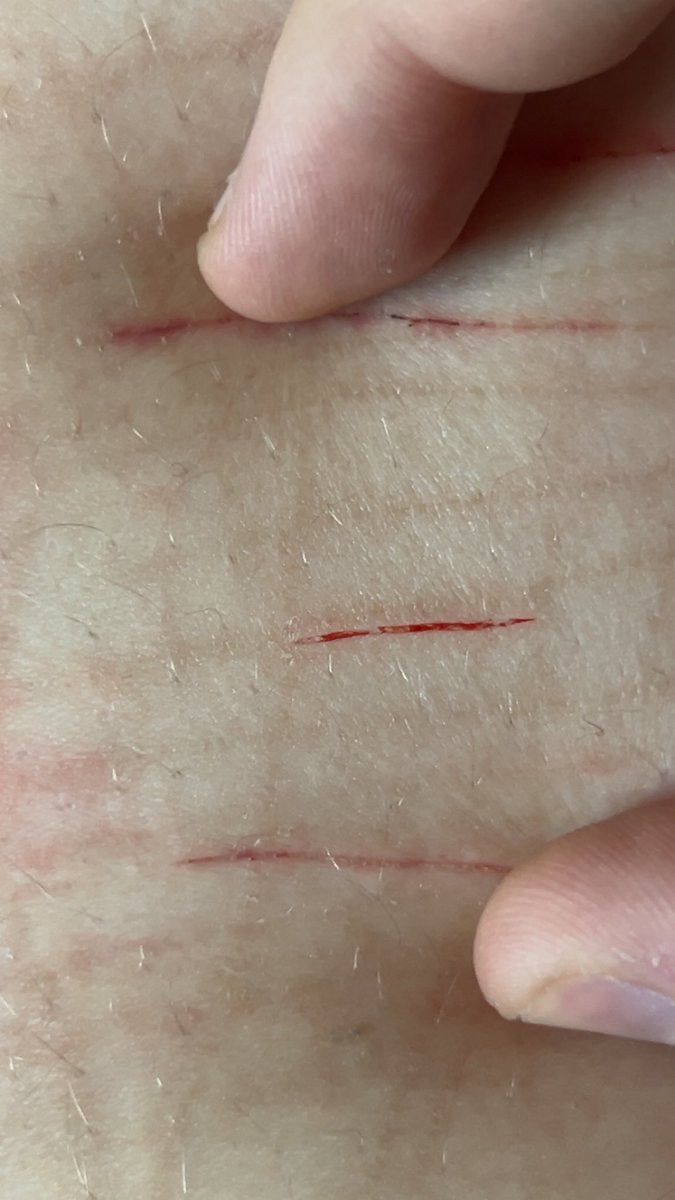 thalasaphobic's tweet photo. Not feeling well today…૮꒰◞ ˕ ◟ ྀི꒱ა
sfx makeup
#shtet #sh #slittwt #styros https://t.co/pubnqbbNjY