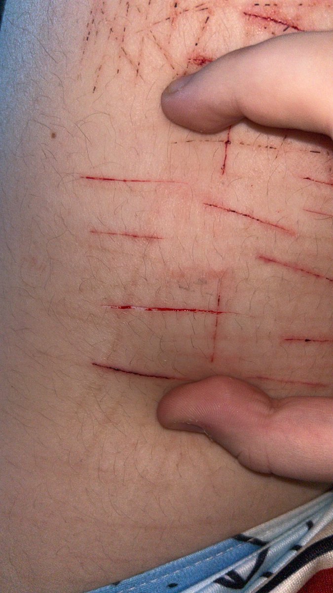 thalasaphobic's tweet photo. Not feeling well today…૮꒰◞ ˕ ◟ ྀི꒱ა
sfx makeup
#shtet #sh #slittwt #styros https://t.co/pubnqbbNjY