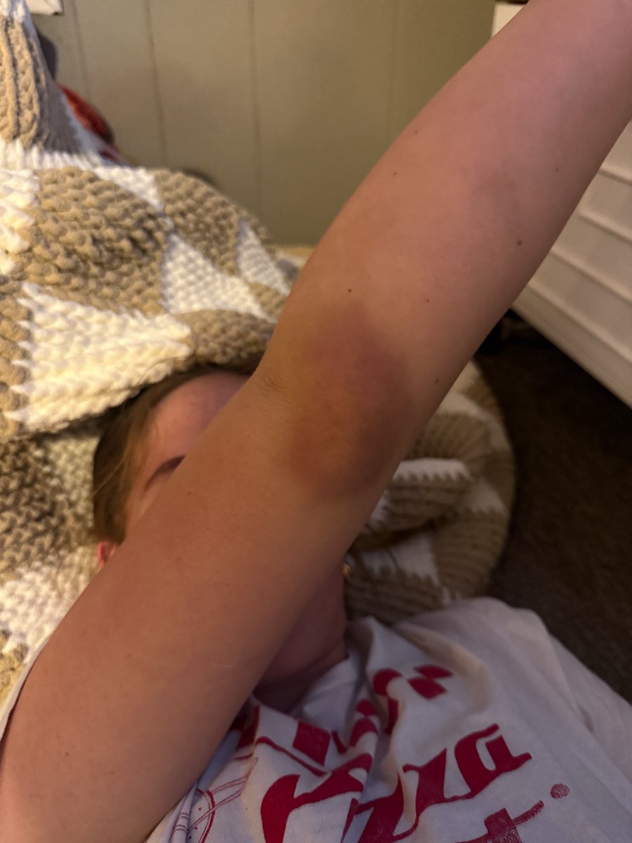 declan_sanro's tweet photo. Going all out sometimes means battle wounds #worthit https://t.co/Poo9NZmzUv