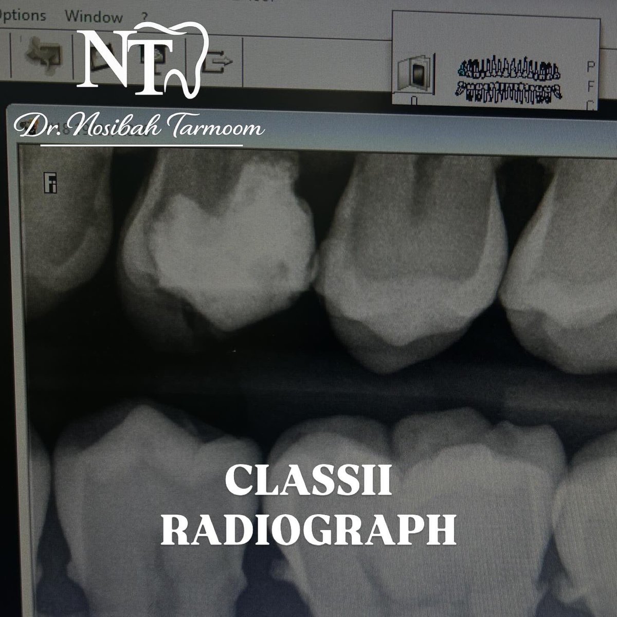 A Class II composite restoration was performed on tooth #25 (mesial surface). Caries removal was completed, followed by composite resin placement.

The cavity extended close to the gingival margin, which made the procedure slightly challenging.