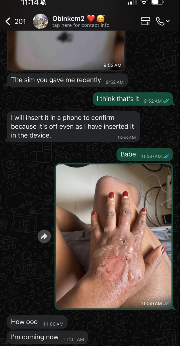 Jenyking's tweet photo. The Best April fool prank I have seen today.
A girl pranked her man with an AI generated burnt hand. Check pictures for his reaction.

Kenneth Okonkwo Happy New Month #josisbleeding Extreme Amen Italy World Cup April Fool Nigerians https://t.co/hZoCruJVuz