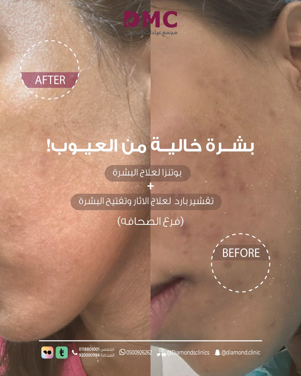 بشرة خالية من العيوب ✨
مو حظ … هي خطة علاجية مدروسة 👌🏻
مع تقنية البوتنزا + التقشير البارد
نستهدف الآثار، نوحّد لون البشرة، ونرجّع نضارتها من جديد
لأن بشرتك تستاهل العناية الصح ✨

•
•

#عيادات_الماسي
#ليفارا_براند_سعودي 
#ام_فهد__تنخااكم_منصه_احسان
#هنا_القاهره_هنا_الرياض