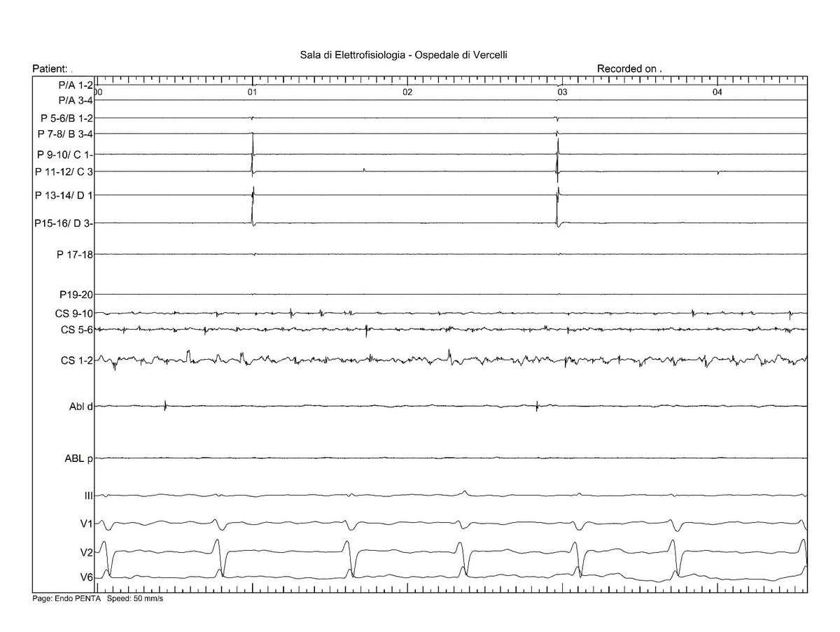 assurdani's tweet image. Funny dissociated PV potentials after my first ❤️ #PVI