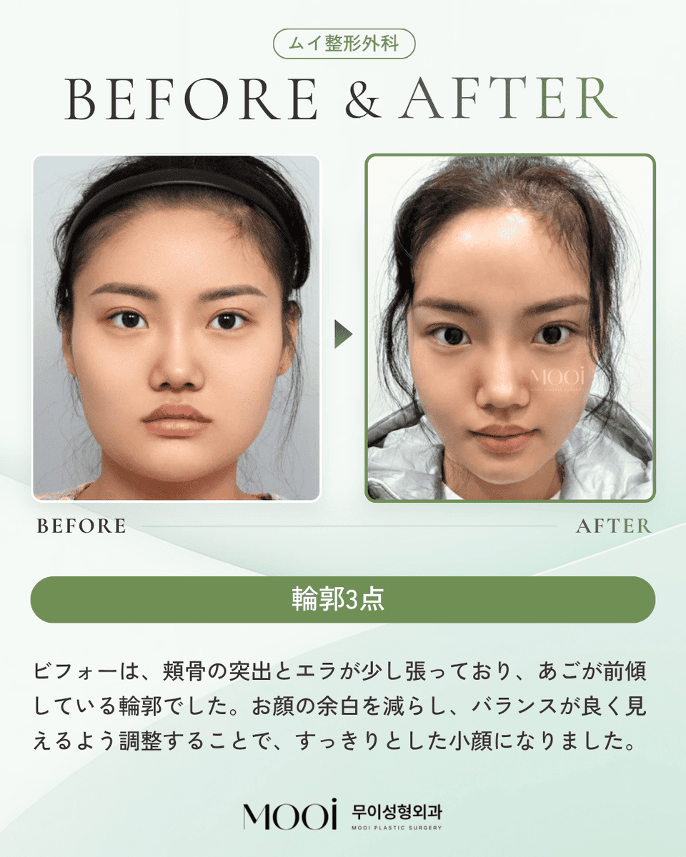 MOOi (ムイ) 整形外科 tweet media