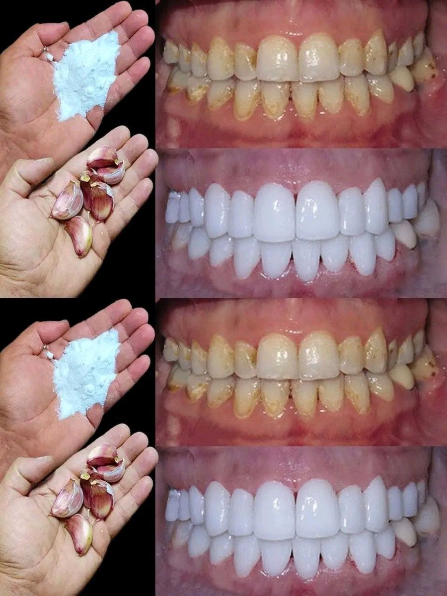 strength_km's tweet photo. Pour garder un sourire éclat 
Il faut avoir les dents propre et blanche 

Voici comment vous pouvez blanchir vos dents rapidement et naturellement en moins de 5min….Voir plus https://t.co/GoGL5OEvKs