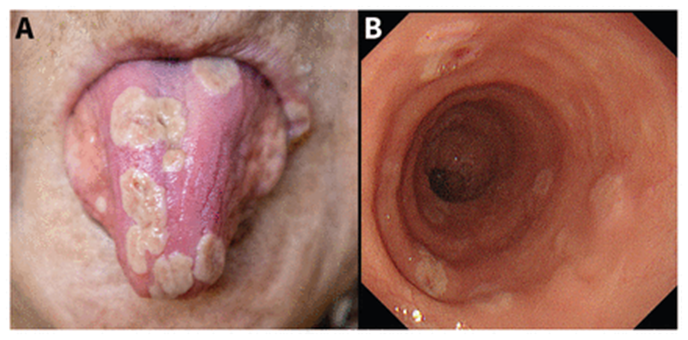 guerreroespejo's tweet image. An 81-YO woman, type 2 diabetes mellitu: fever with oral pain, odynophagia &amp;amp; multiple yellowish-white, pseudomembranous lesions on the patient’s tongue.

Esophagogastroduodenoscopy showed multiple shallow ulcers with a white coating
1/3

doi.org/10.1503/cmaj.2…
#Medicine #IDpost