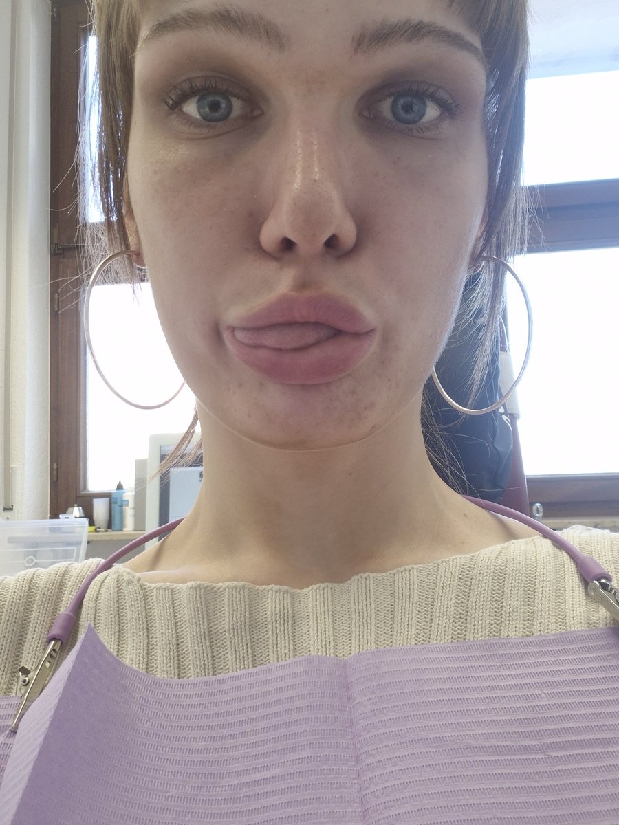 amdreedx's tweet image. Looking bloated ASF at the #dentist