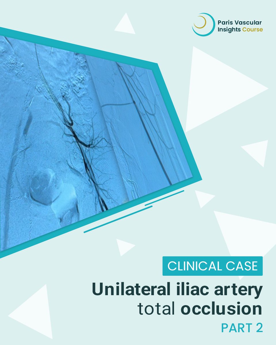 ParisVascular's tweet image. Unilateral iliac artery total occlusion 🔍
A 67-year-old woman with a heavy cardiovascular history presented with Rutherford III–IV symptoms, combining short-distance claudication and rest pain. 
A challenging anatomy. ➡️ brnw.ch/21x1fYK
#PVI #vascular #aorta
