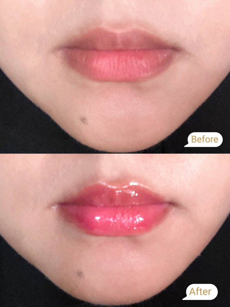 afiyahfdh's tweet photo. Bibir kering atau pecah-pecah lagi? Udah nggak jaman! 😌✨  

Akhir-akhir ini aku lagi obsessed sama Lip Ice Juicy Lip Serum. Hasilnya bikin bibir keliatan sehat, lembab, dan glowing banget setiap hari!  

Siapa yang bibirnya suka kering? Ini wajib coba deh 💕 https://t.co/CeuWAbm1RE