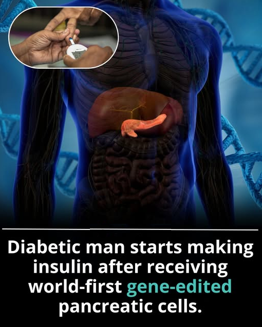 Great step in the right direction. Type I diabetes was always thought to be due to an auto immune enemy on pancreatic beta islet cells early in life resulting in no insulin production. Hence creating edited, hypo immune cells makes sense as they will not get attacked.